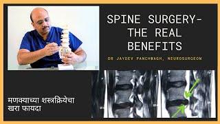 The Real Benefits of Spine Surgery for Nerve Compression | मणक्याच्या शस्त्रक्रियेचा खरा फायदा..