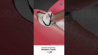 Wisdom Tooth Removal Surgery ↪ 3D Medical Animation #Shorts #WisdomTooth #Tooth #Surgery