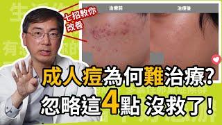 為什麼成人痘很難治療？男生會長成人痘嗎？皮膚科醫師指出，忽略這4點，治療效果就不好！