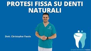 Protesi fissa su denti naturali