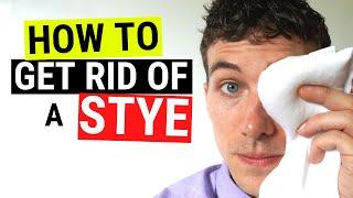 How to Get Rid of a Stye FAST - Chalazion VS Stye Treatment