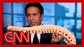 Sanjay Gupta gives demonstration on Mangione's apparent spine condition