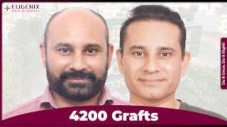 Best Hair Transplant in India | Travel from Dubai to Eugenix for Hair Restoration