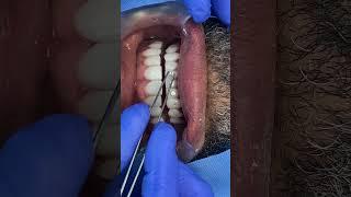 Diamond Unilaser smile | Smile design with bonding veneers and diamonds