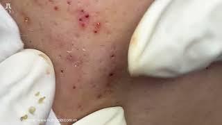 Big Cystic Acne Blackheads Extraction Blackheads & Milia, Whiteheads Removal Pimple Popping