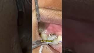 Remedio Casero para Solucionar una Gran CARIES  que traerá MUCHOS PROBLEMAS