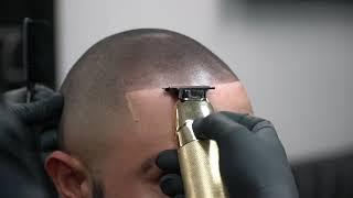 Scalp Micropigmentation in Scottsdale