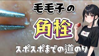 【角栓】じれったい角栓抜き。スポスポ抜きを修行中