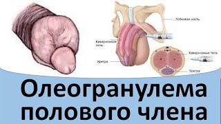 Олеогранулема полового члена