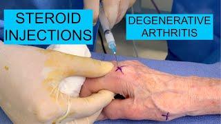 Steroid Injections for Degenerative Arthritis