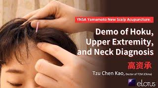 YNSA Yamamoto New Scalp Acupuncture: Demonstration of Hoku, Upper Extremity, and Neck Diagnosis