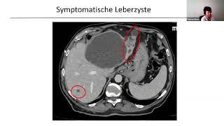 How I do it -  Leberzysten - Viszerale Chirurgie