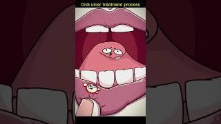 Oral ulcer treatment process