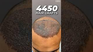 4450 Hair Grafts | Sapphire FUE Hair Transplant By Dr. Mohd Asif at CARA