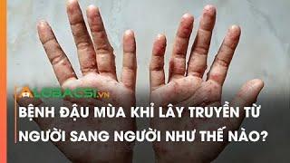 Bệnh đậu mùa khỉ lây truyền từ người sang người như thế nào?