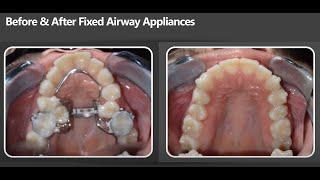 Airway Chat #1 with Dr Ben Miraglia: Airway Expansion Appliances (Palatal & Lower Expanders)