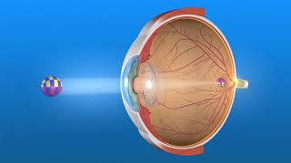 How does a monofocal IOL works in the eye after cataract surgery? | EYE NEWS TV