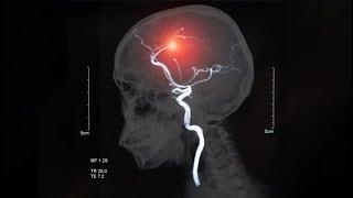 When should my stroke patient be sent for EVT therapy? What Emergency Doctors Need to Know