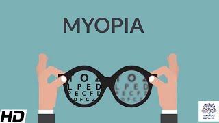 Myopia, Signs and Symptoms, Causes, Diagnosis and Treatment.