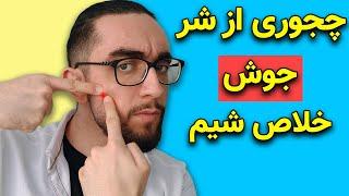 چجوری "یک شبه" از شر جوش خلاص شیم | درمان سریع جوش صورت