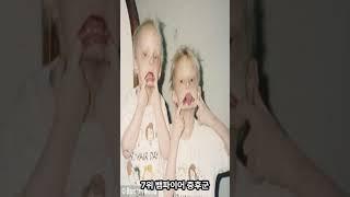 세계에서 가장 희귀한 질병 TOP 10