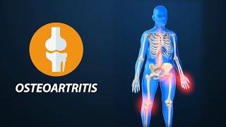 Medicina para todos: Dolores articulares, osteoartritis