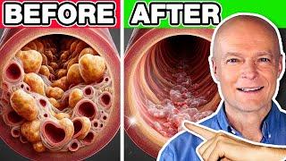 Top 10 Best Vegetables To Unclog Arteries Naturally & Prevent Heart Attack