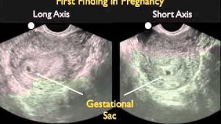 How To: Intrauterine Pregnancy - Part 1 Case Study Video