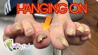 Why It's Important to Get Your Nails Trimmed (Starring: a Loose Nail)