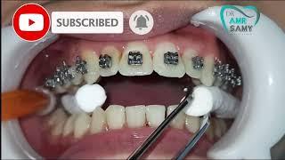 Steps of putting on orthodontic braces and wire