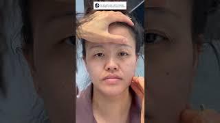 Transformative Double Eyelid Surgery Pre-op Evaluation | Dr. Kenneth Kim