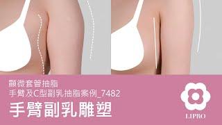 手臂副乳雕塑｜顯微套管抽脂｜手臂及C型副乳抽脂案例_7482