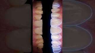 Full mouth transformation with veneers! #dentaltech #veneers #shorts #edit #dentistry