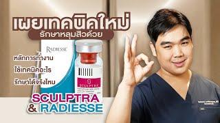 เผยเทคนิคใหม่ Sculptra & Radiesse #รักษาหลุมสิว ! มีหลักการยังไง รักษาได้จริงไหม? อยากหน้าใสต้องดู!