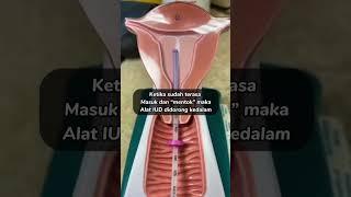 CARA MEMASUKAN KB IUD KEDALAM RAHIM!! | KB SPIRAL DALAM RAHIM! #kb #kbiud #tipskbiud #kbspiral