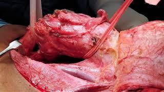 Total Laryngo Pharyngo Esophagectomy & Gastric Pull Up