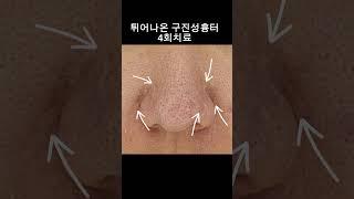 튀어나온흉터 구진성흉터도 치료가됩니다.#튀어나온흉터 #구진성흉터#흉터치료 #피부관리