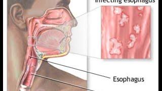 Candida Esophagitis