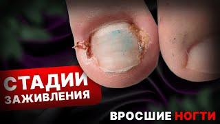 Лечим дома вросшие ногти! Чудо-капли?!! Почему о них все молчат? Стадии заживления.@Podolog__eva