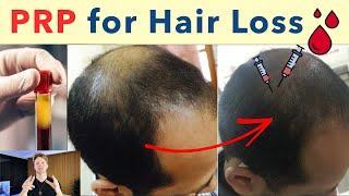 PRP for Hair Loss - Do Platelet Rich Plasma Treatments actually work? (NOT Worth it?)