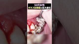 ギネス記録級の歯石がもう"歯岩"すぎる！！#歯石除去  #ザホワイトデンタルクリニック #歯医者