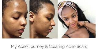 My Acne Journey: Acne Scar Clearing Skincare Routine | MIHLALI N