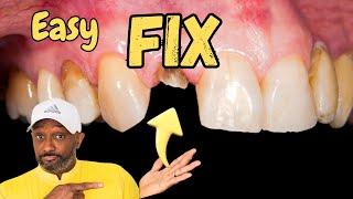 Dental Care Kit | Fix Your Cosmetic Dentistry Yourself | How To Fix A Broken Tooth