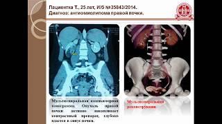 Ангиомиолипома почки. Малоинвазивные методы лечения.