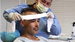 Bosley FUE Procedure Edgar's Journey (Hair Transplant - How It's Done)