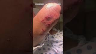 Swimmer was attacked by otters in a California lake