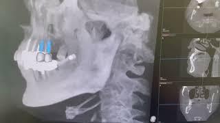 Digital X-Rays at Dental Wellness of Charlotte