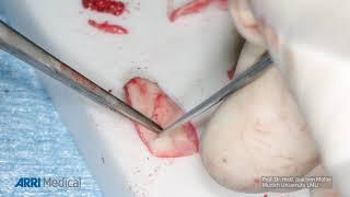 ARRISCOPE Application Video - Cholesteatoma removal