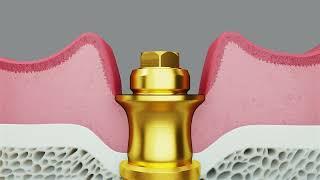 Meet the new Multi-unit Abutment for Conical Connection