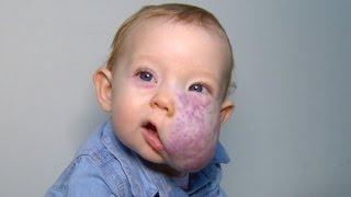 See 2-Year-Old's Incredible Transformation After Surgery To Remove Facial Tumor